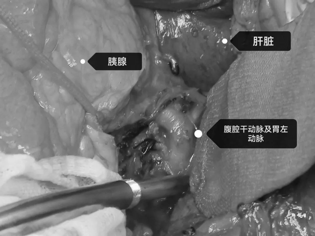 这颗「一碰就炸」的肿瘤，被他们顺利切除……