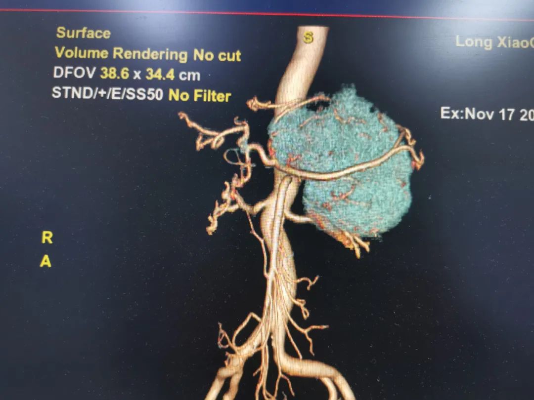 这颗「一碰就炸」的肿瘤，被他们顺利切除……