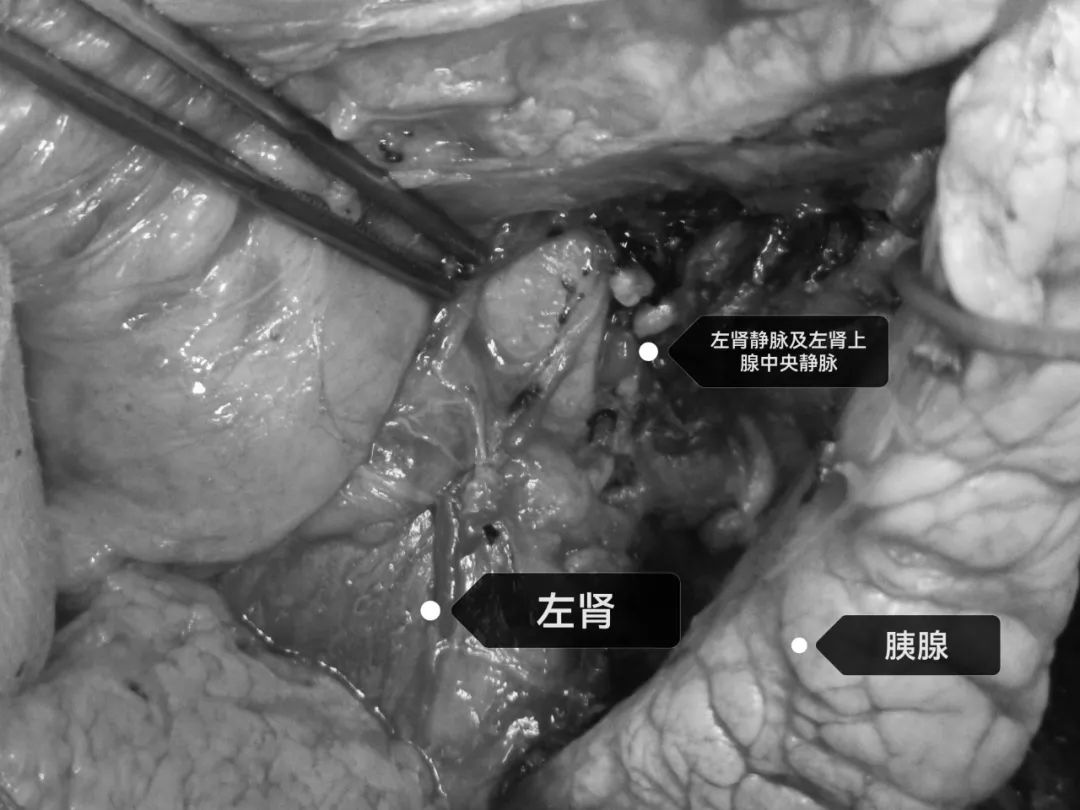 这颗「一碰就炸」的肿瘤，被他们顺利切除……