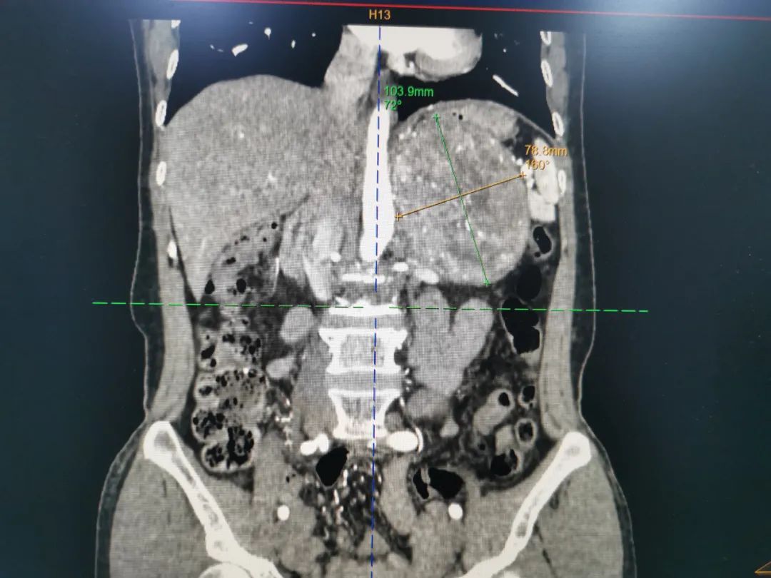 这颗「一碰就炸」的肿瘤，被他们顺利切除……