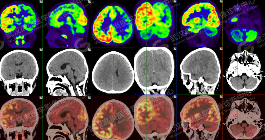 高尚病例：18F-FDG PET/CT 在癫痫中的应用