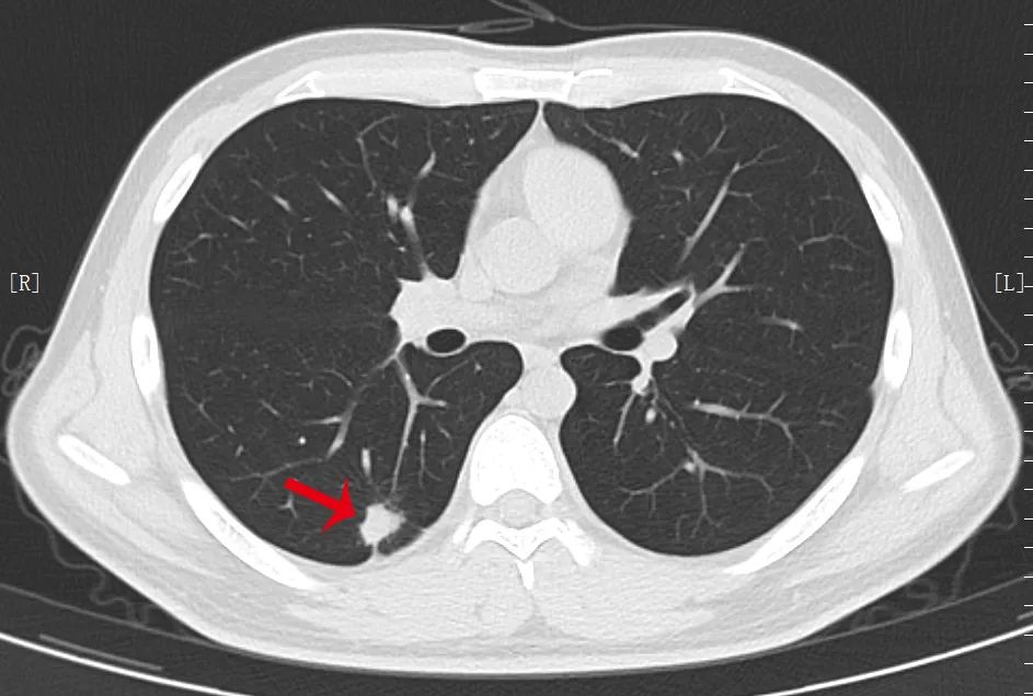 都是肺结节，为什么有的需要手术，有的不用？