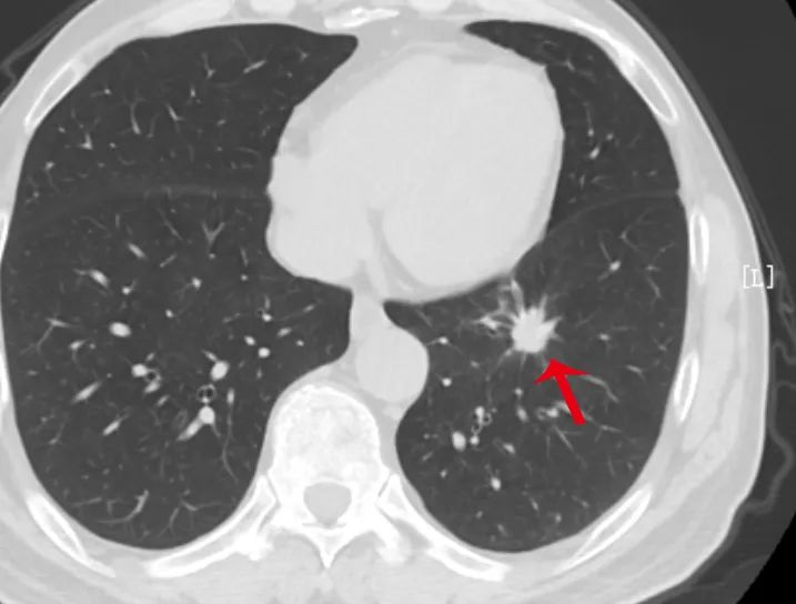 都是肺结节，为什么有的需要手术，有的不用？