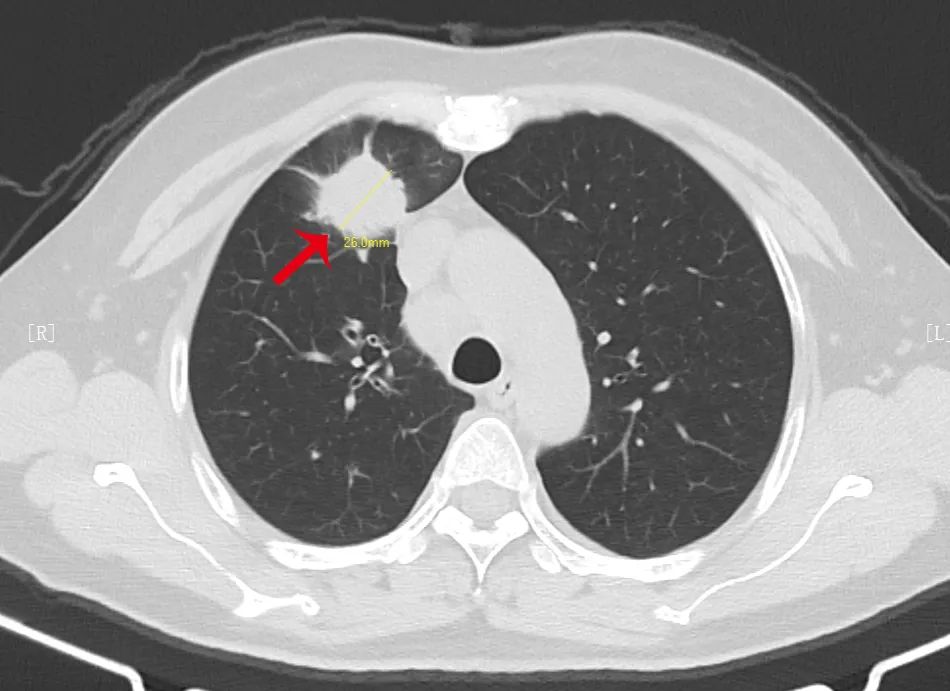 都是肺结节，为什么有的需要手术，有的不用？