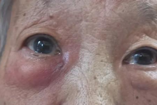 84 岁婆婆流泪半年，眼睛多次红肿痛不欲生