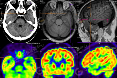 高尚病例：18F-FDG PET/CT 在癫痫中的应用