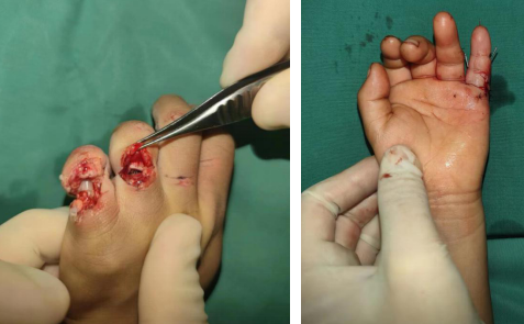 5 岁男童被榨油机绞断手指，徐州仁慈医院连夜抢救断指再植！