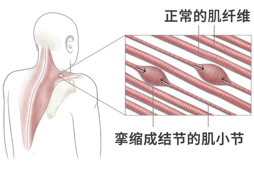 肌肉纤维痛图片