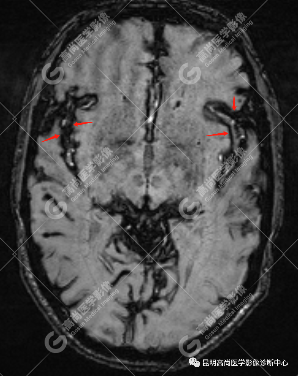 高尚病例：中枢神经系统表面铁质沉积症一例