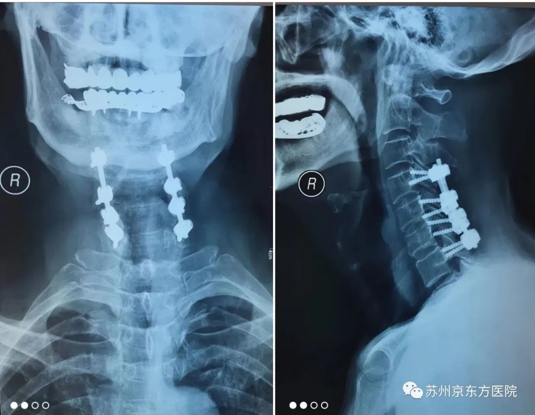六旬老人骑电车摔跤,竟当即瘫痪?