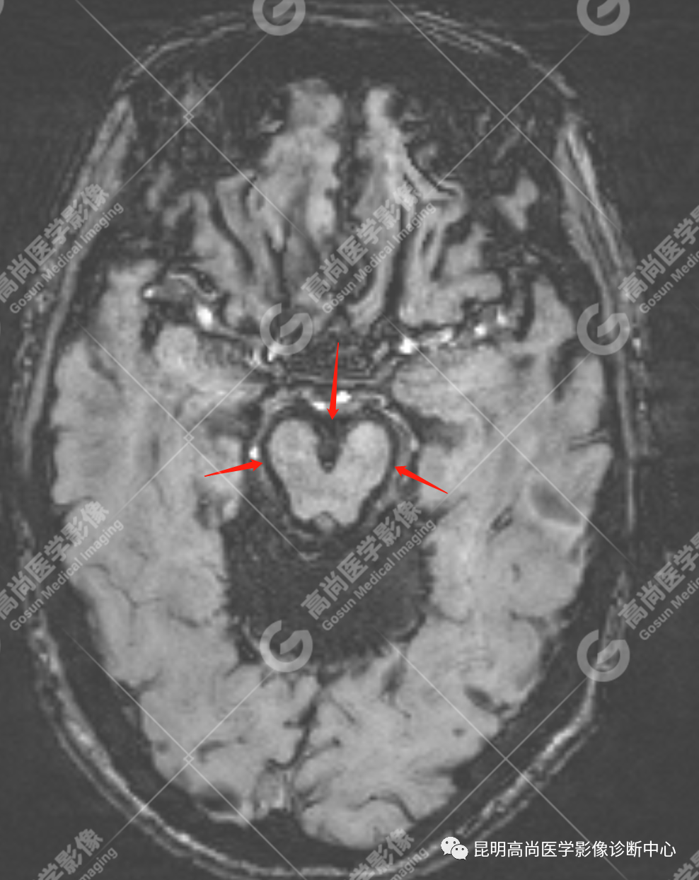 高尚病例：中枢神经系统表面铁质沉积症一例