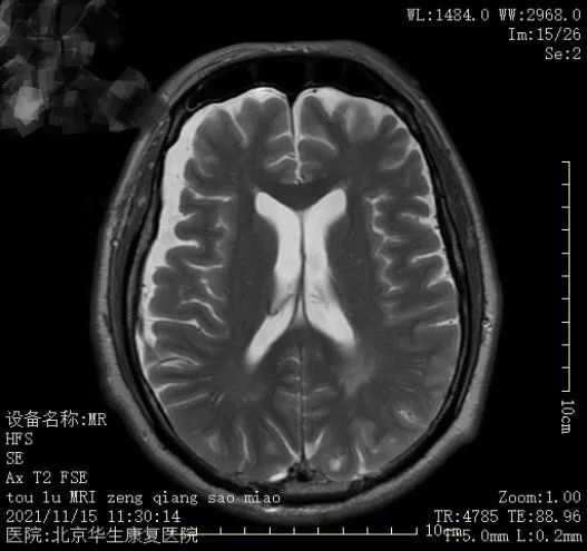【神经康复科病例分享】脑出血康复