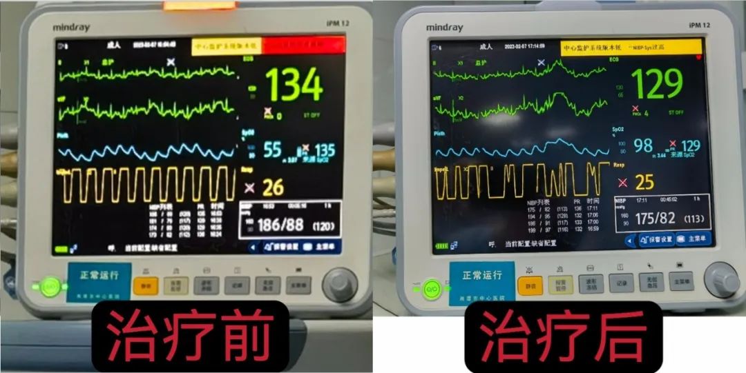 紧急介入，畅通呼吸——湘潭市中心医院创新开展一例气管支架置入术