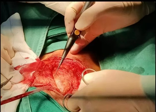 耳垂下方长出包块,不痛不痒,一查竟是腮腺癌!