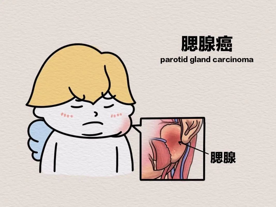 耳垂下方长出包块,不痛不痒,一查竟是腮腺癌!