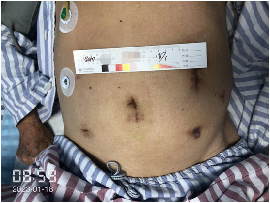 查「瘘」补缺 | 广西壮族自治区人民医院治愈一名高龄肠瘘患者