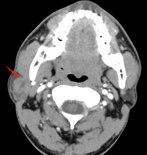 耳垂下方长出包块,不痛不痒,一查竟是腮腺癌!