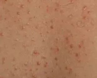 湿度「狂飙」的回南天，皮肤又红又痒，需警惕这些皮肤病