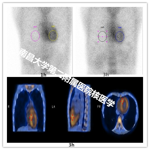 南昌大学二附院应用 99mTc-PYP 核素显像技术完成 ATTR-CM 首次诊断
