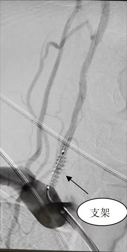 「我是家里的顶梁柱，可不能倒下！」55 岁的老张突然头晕、乏力……