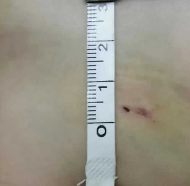 治病又纾困 | 广西壮族自治区人民医院助先天性心脏病双胞胎患儿重获「心」希望