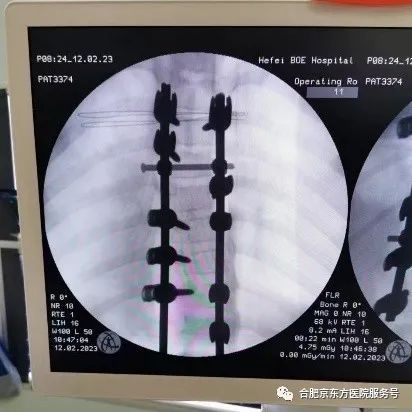 合肥京东方医院成功开展首例脊柱侧弯手术
