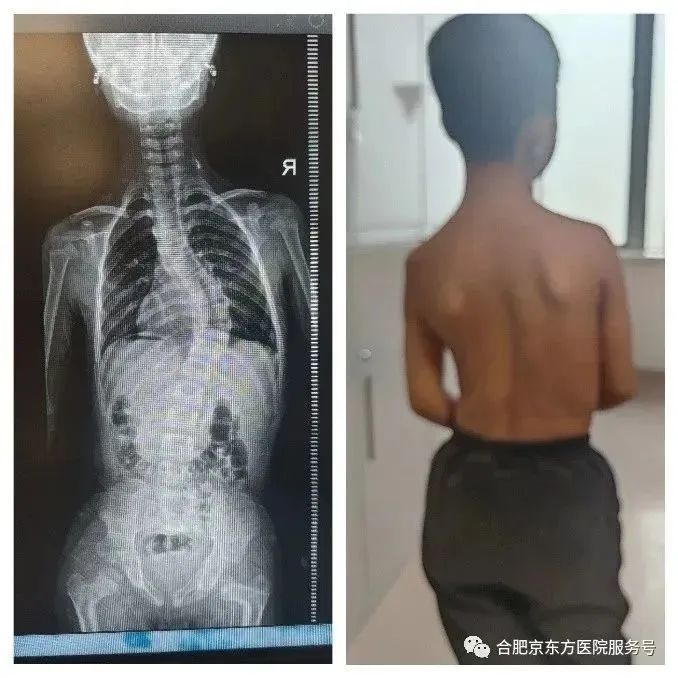 合肥京东方医院成功开展首例脊柱侧弯手术