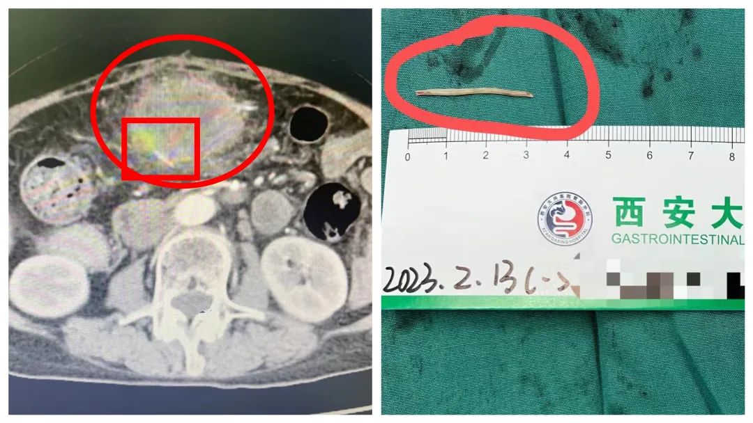 老人喝了碗鱼汤致开腹切胃，「土办法」可治不了鱼刺