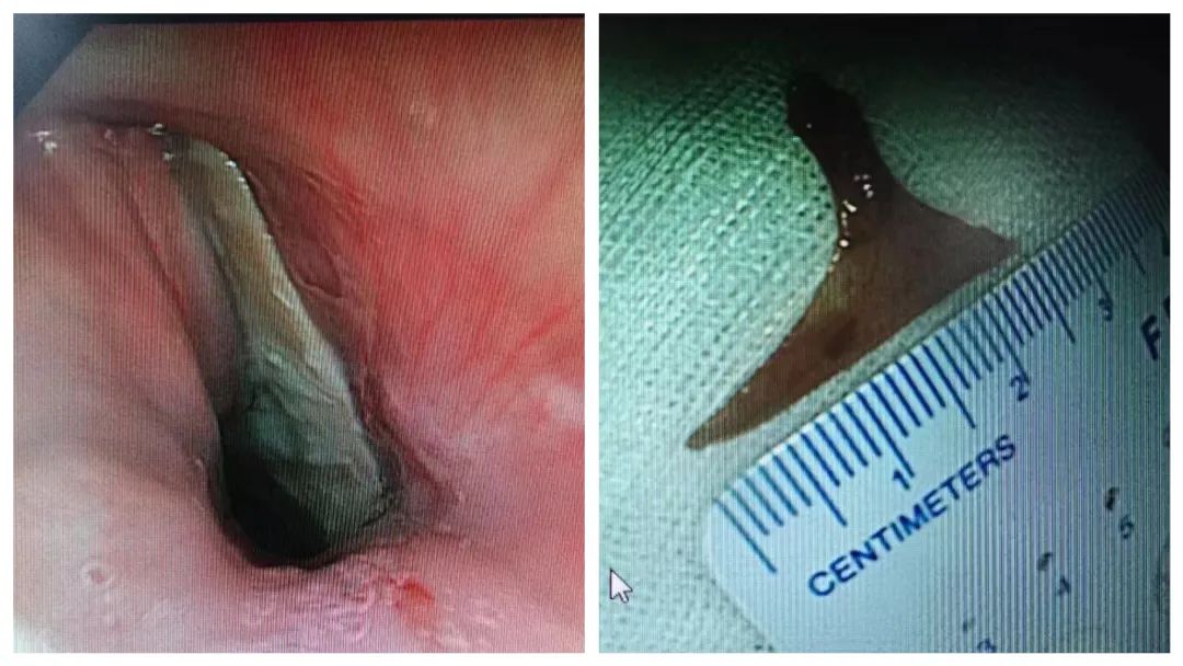 老人喝了碗鱼汤致开腹切胃，「土办法」可治不了鱼刺