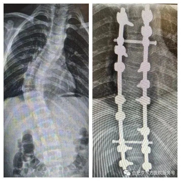 合肥京东方医院成功开展首例脊柱侧弯手术