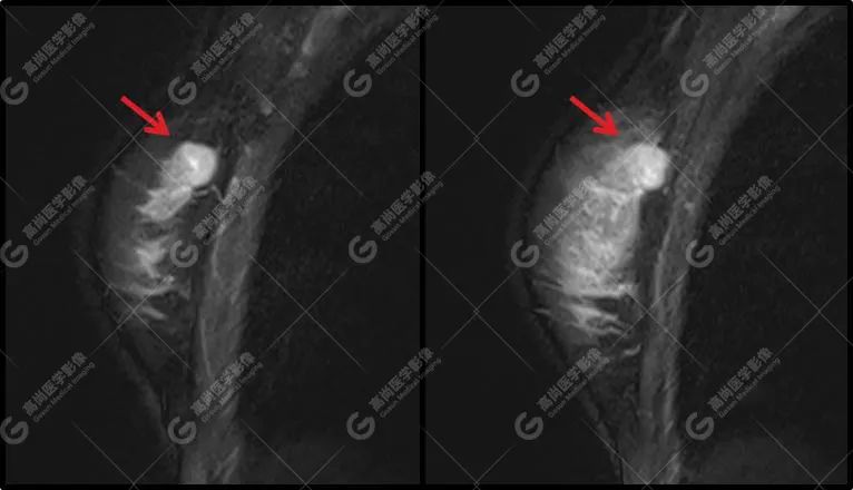 高尚病例：病理证实：MR 平扫+动态增强诊断乳腺浸润性导管癌 1 例