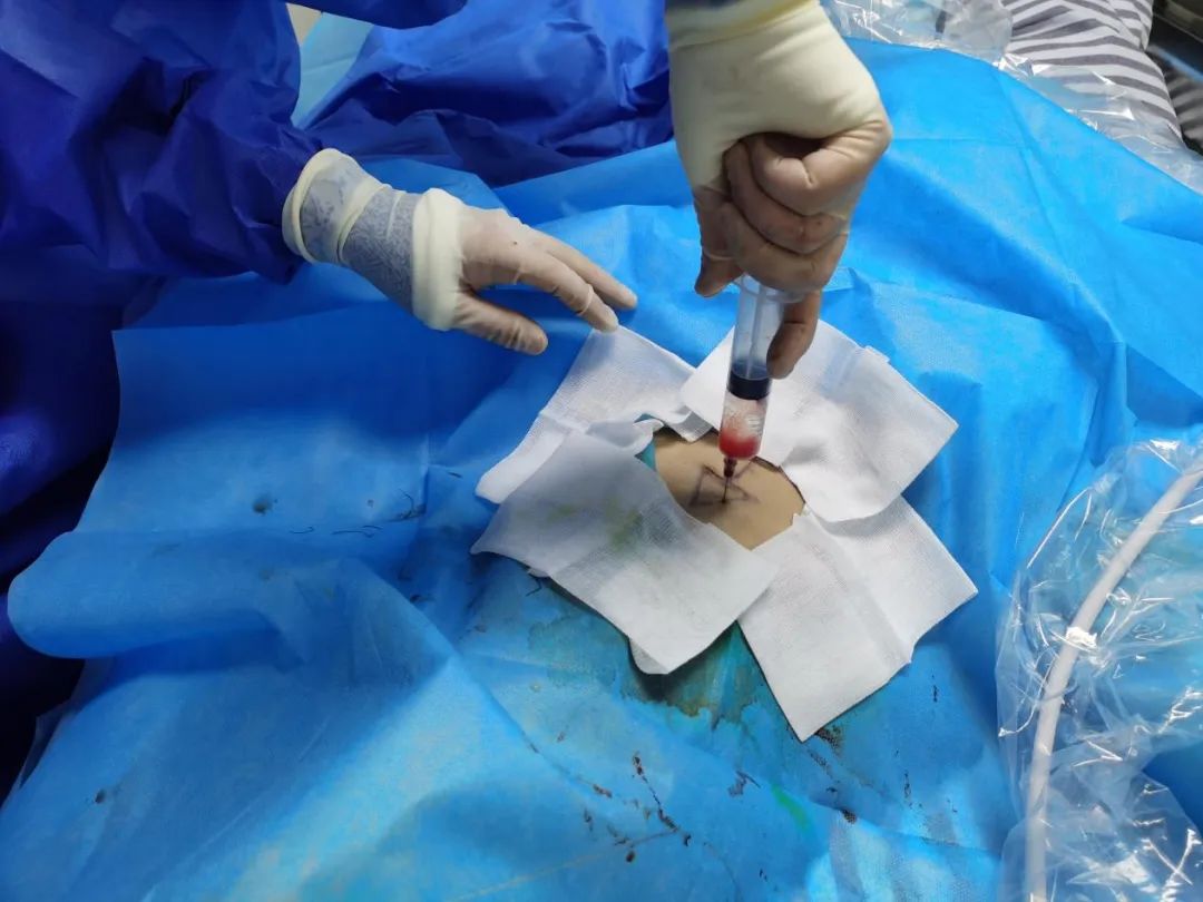 建立「隐形生命线」 | 广西壮族自治区人民医院为淋巴瘤患者经股静脉置入输液港