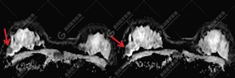 高尚病例：病理证实：MR 平扫+动态增强诊断乳腺浸润性导管癌 1 例