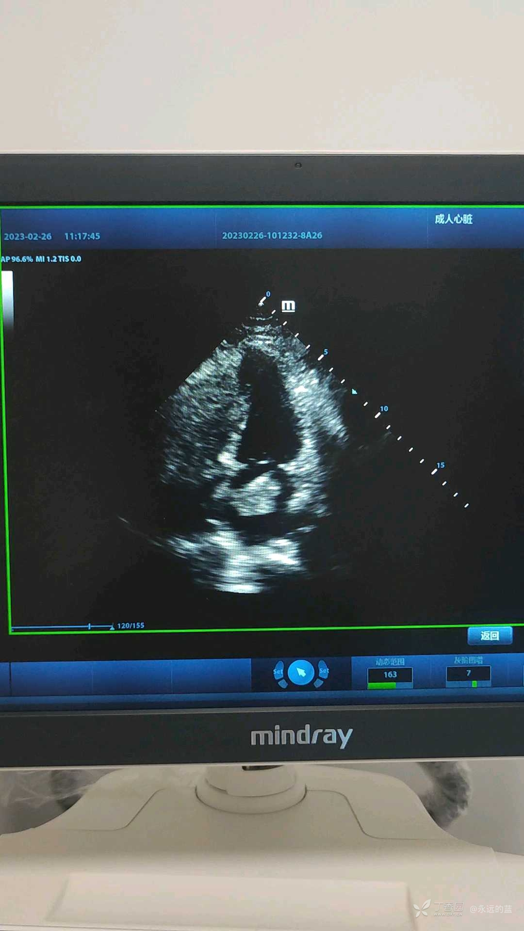 心脏粘液瘤超声图片图片