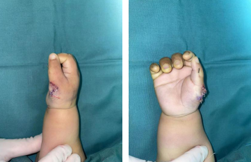 1 岁男童右手长个「小尾巴」，徐州仁慈医院成功为其手术矫形