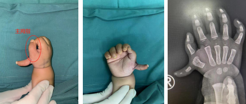 1 岁男童右手长个「小尾巴」，徐州仁慈医院成功为其手术矫形