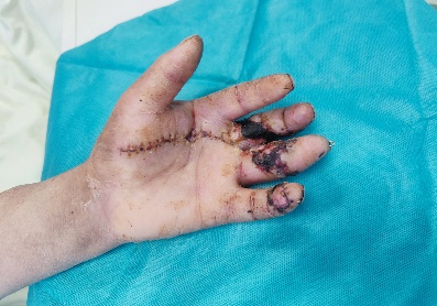 左手保卫战！南京江北医院手足显微外科全力拯救电锯手外伤