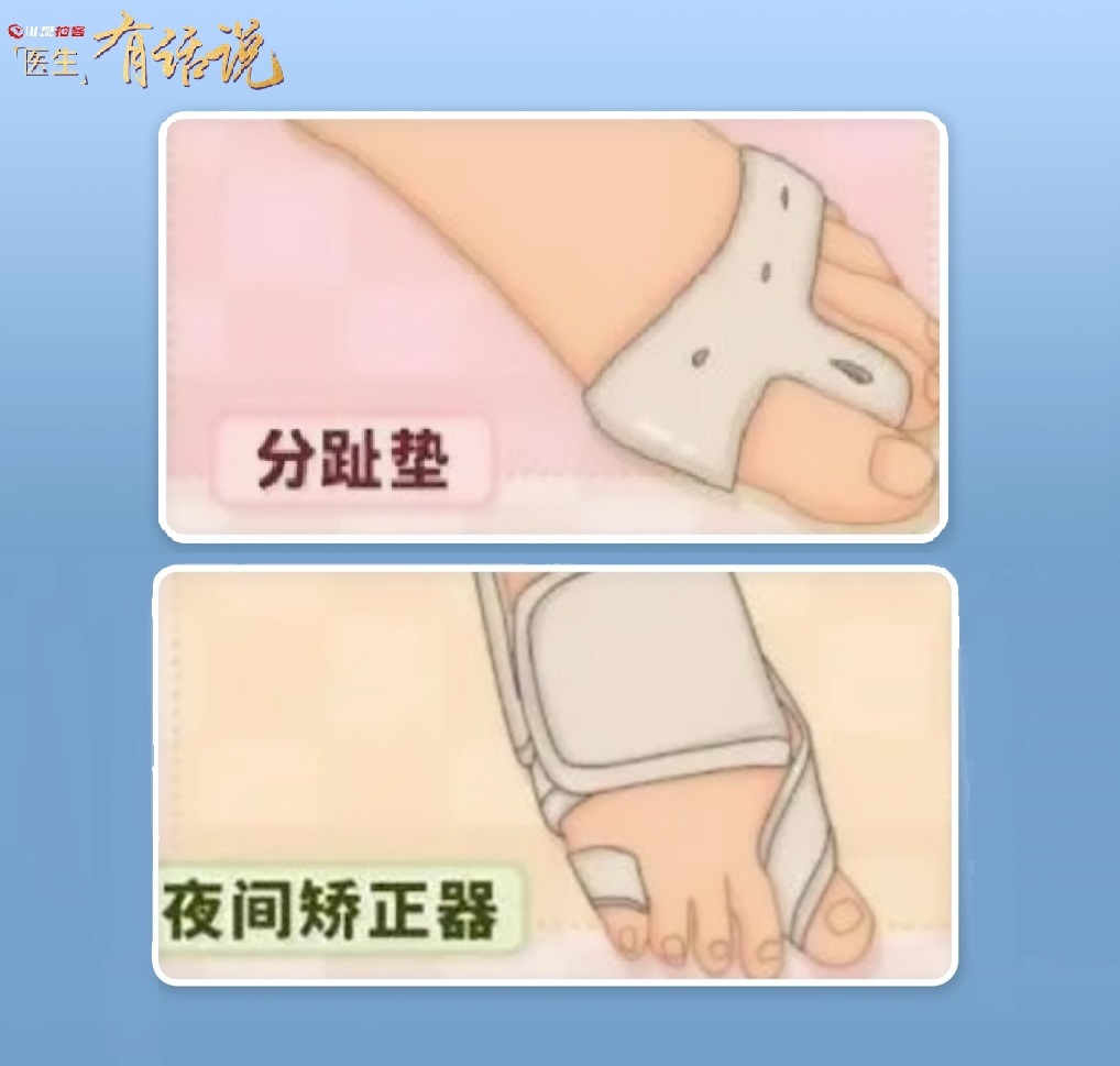 成都京东方医生有话说：拇外翻「足」以影响你的美