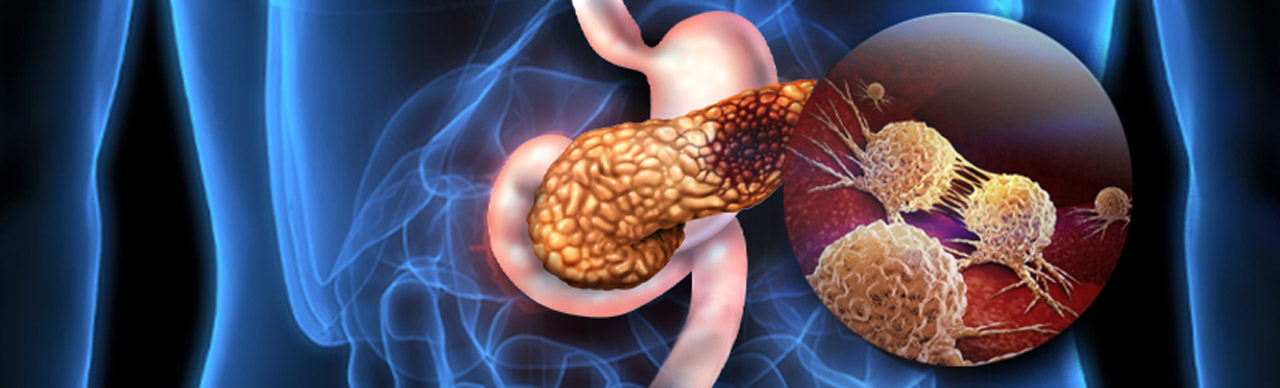 肿瘤微环境细胞相互作用驱使胰脏肿瘤恶化之机制