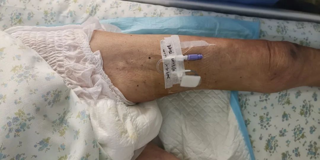 荆门市中医医院成功开展院内首例下肢大隐静脉置入中长导管术