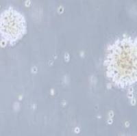 NK92人恶性非霍奇金淋巴瘤患者的自然杀伤细胞