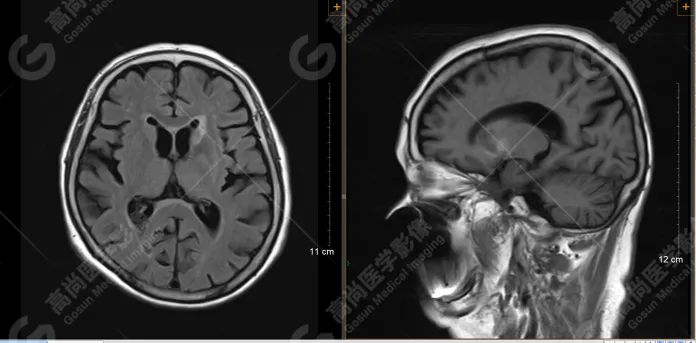 高尚病例：糖尿病高渗状态所致颅脑 MRI 病变 1 例