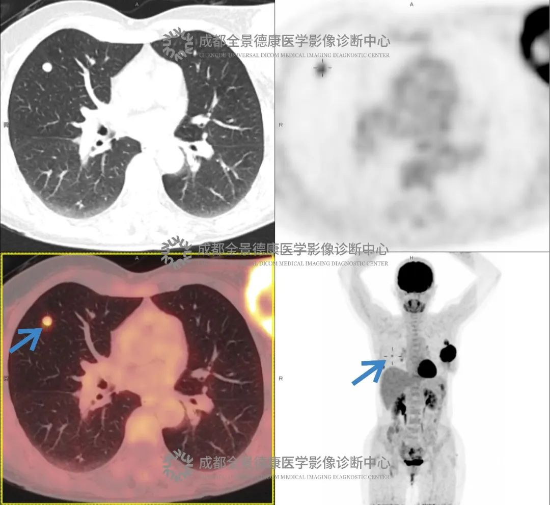 不痛不痒，它在悄悄恶变