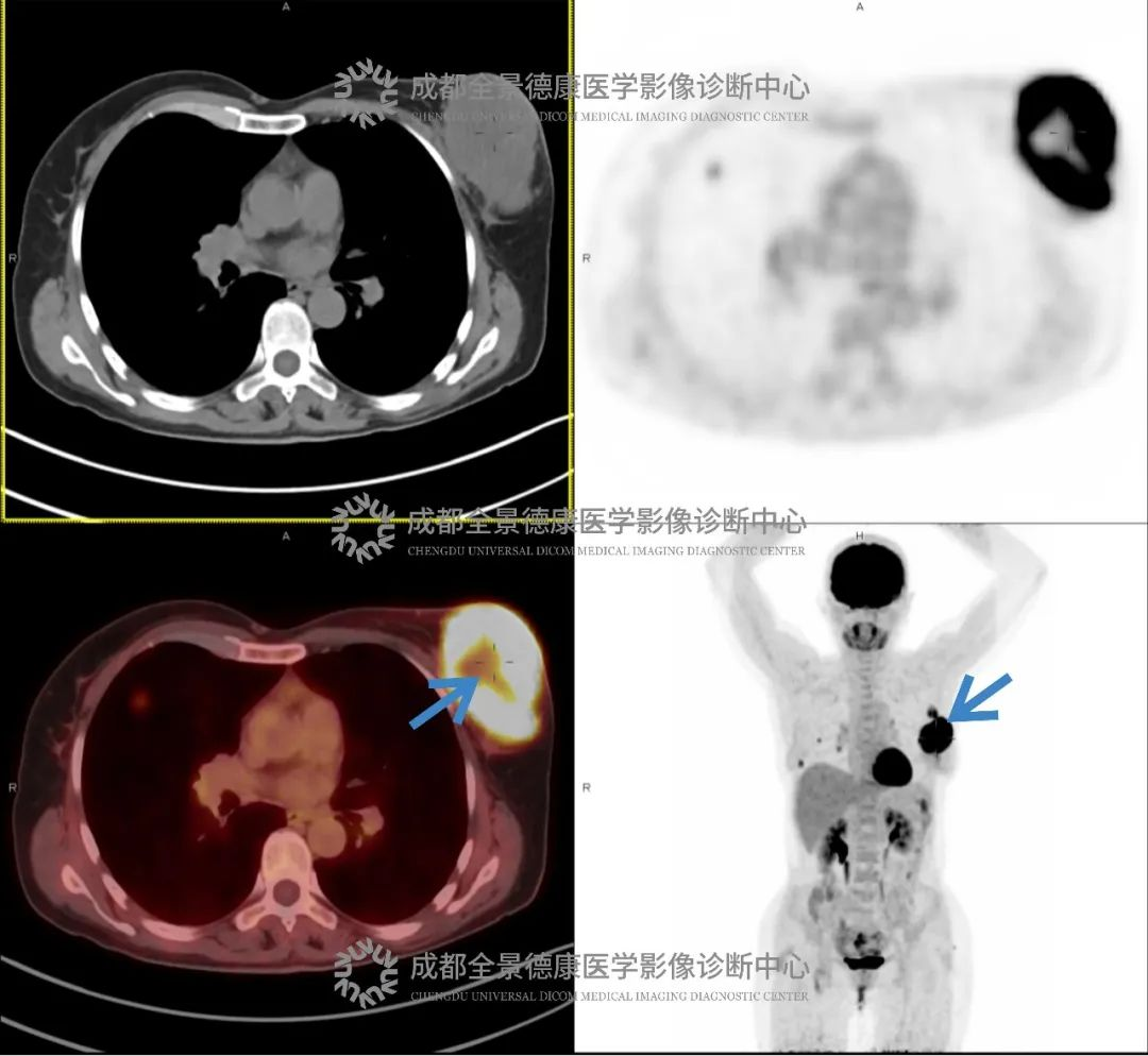不痛不痒，它在悄悄恶变