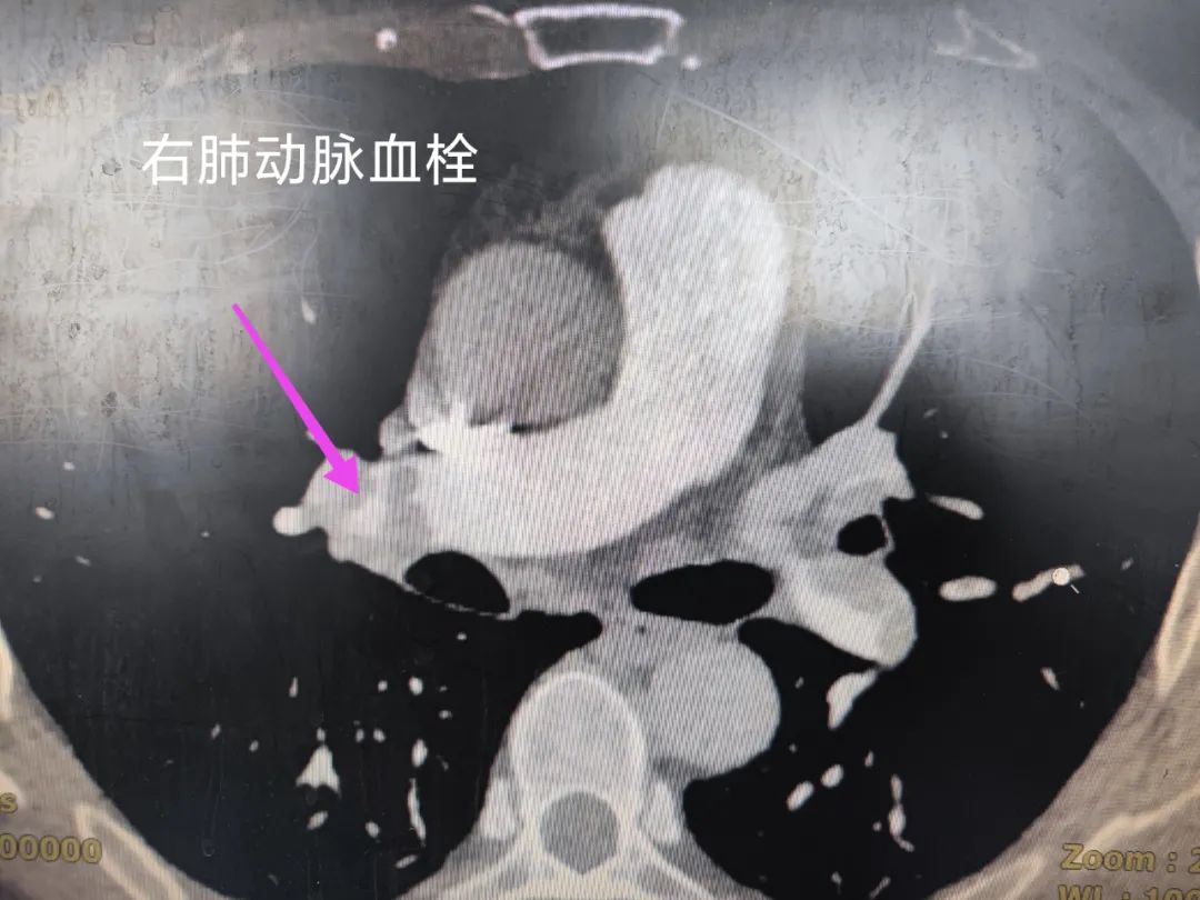 看似小问题 实则大隐患——西安市中医医院心血管疾病科普三则