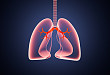 最新！《慢性阻塞性肺疾病急性加重诊治中国专家共识》发布，20 条干货总结在这里！