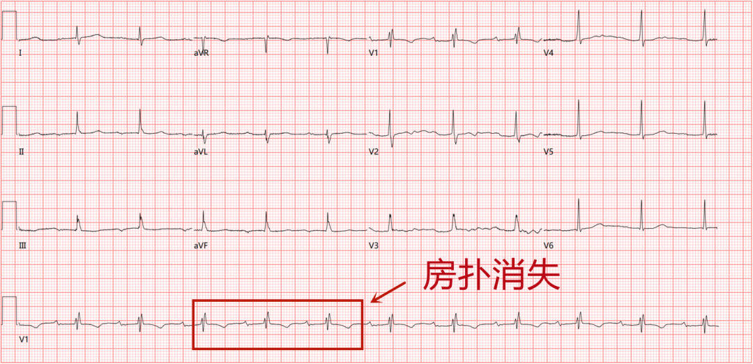 冷冻消融，让心脏不再「躁动」