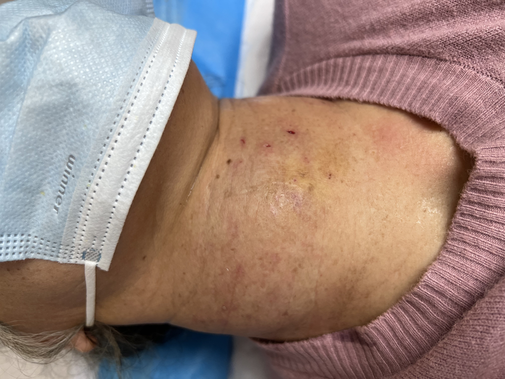 广西壮族自治区人民医院为甲状腺巨大结节患者进行微波消融治疗