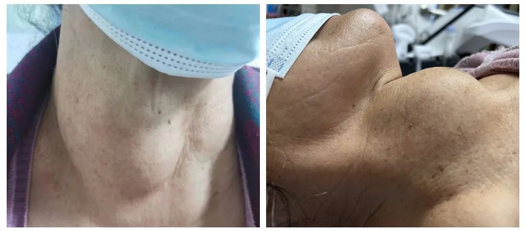 广西壮族自治区人民医院为甲状腺巨大结节患者进行微波消融治疗