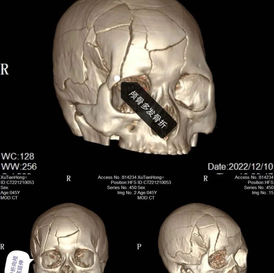 湄潭家礼医院神经外科成功救治一名特重型颅脑损伤患者